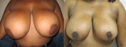 Breast-Reduction-Pt-1