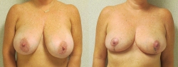 breast-reduction-patient-03a